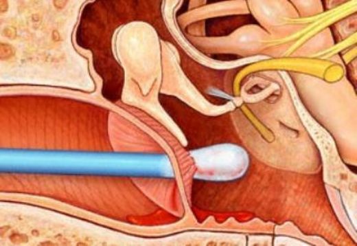 Kulak Temizleme Gliserin Kullanımı ve Faydaları Nelerdir?
